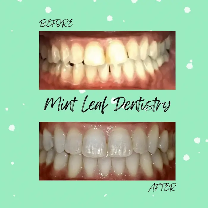 A real Invisalign before-and-after result at Mint Leaf Dentistry