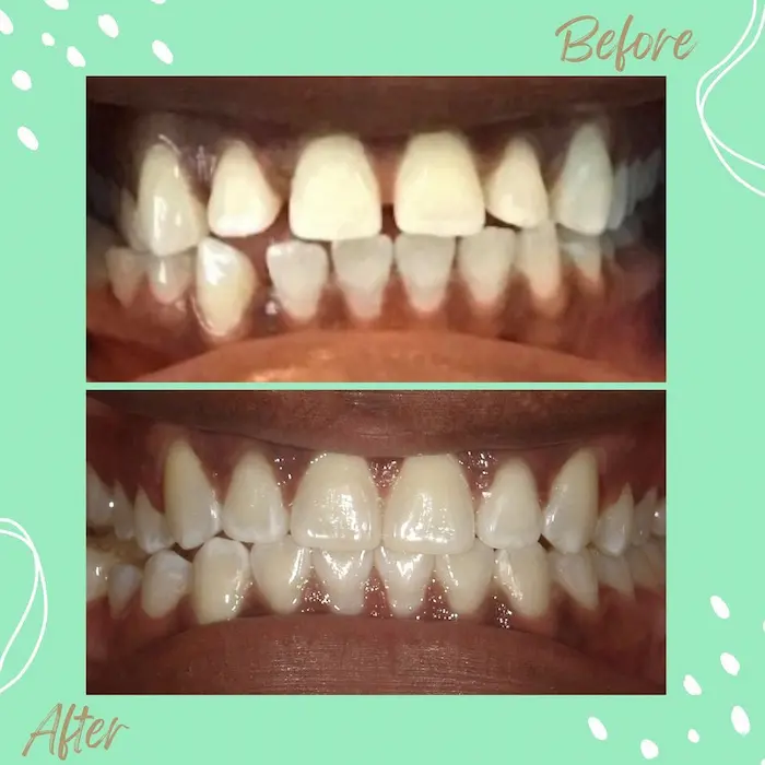 A real Invisalign before-and-after result at Mint Leaf Dentistry
