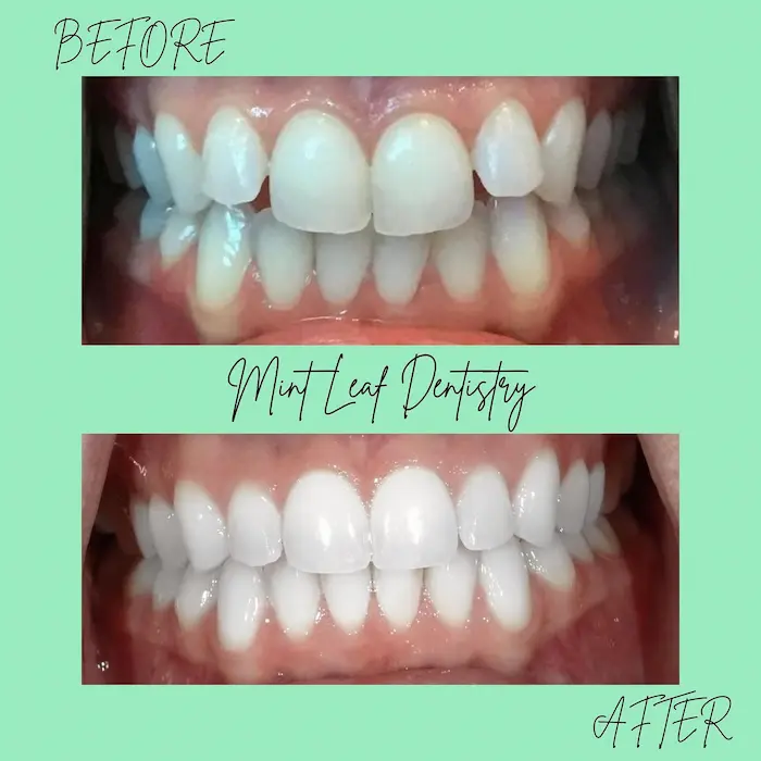 A real Invisalign before-and-after result at Mint Leaf Dentistry