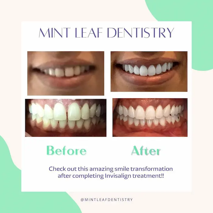 A real Invisalign before-and-after result at Mint Leaf Dentistry